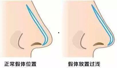假体隆鼻老了后的照片,假体隆鼻术后变化解析